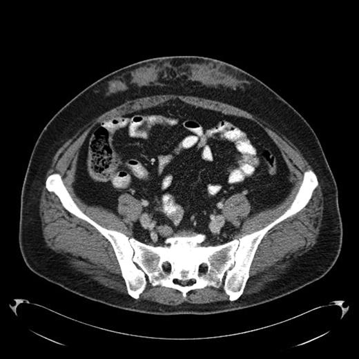 Fig 2. Amyloid infiltration in subcutaneous tissue of lower abdomen at insulin injection site