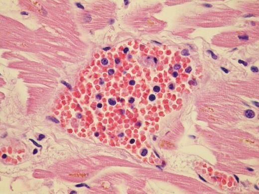 Figure 1:. Myeloid metaplasia – myocardial localization