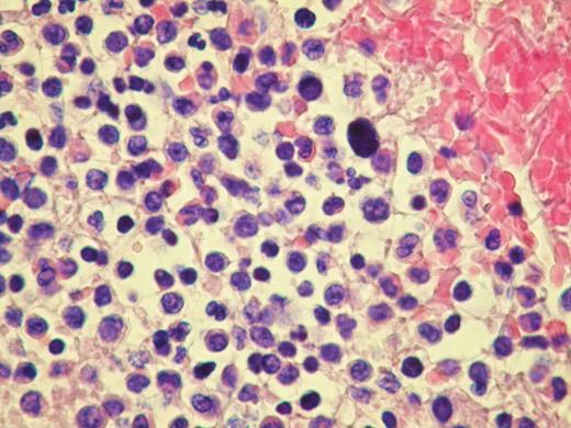 Figure 2:. Myeloid Metaplasia- cerebral venous thrombus