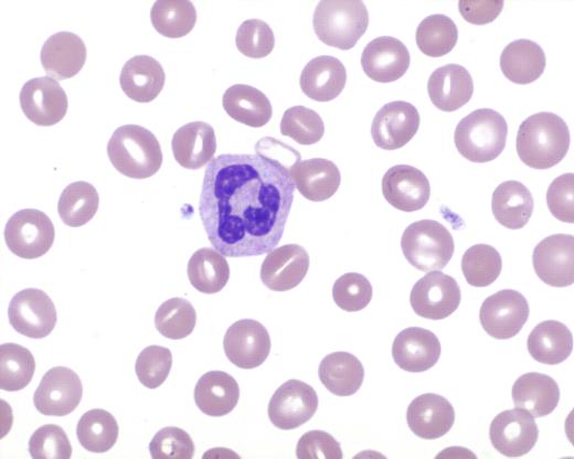 Figure 1. High power field of a peripheral smear photomicrograph exhibiting stomatocytosis.