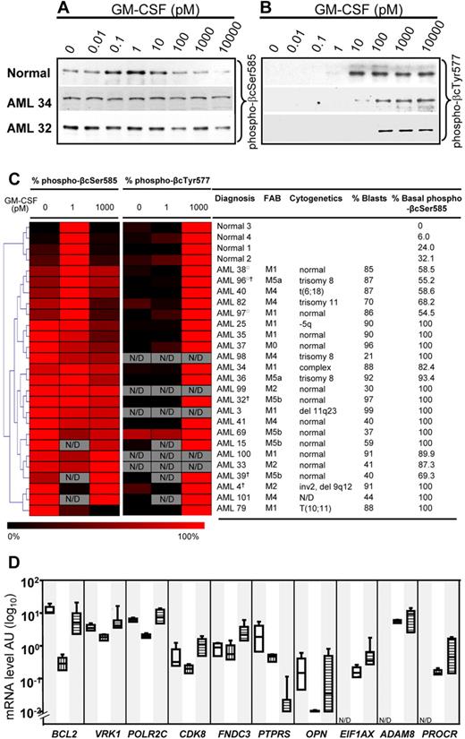 Figure 4. Ser585 phosphorylation is selectively deregulated in AML. MNCs from either healthy donors or patients with AML were stimulated with the indicated concentrations of GM-CSF for 5 minutes. The cells were then lysed, and βc was immunoprecipitated with βc-specific mAbs. Immunoprecipitates were subjected to SDS-PAGE and immunoblotted with affinity-purified phospho-specific anti–phospho-βcSer585 and anti–phospho-βcTyr577 antibodies. Typical results for a healthy donor and 2 AML samples are shown in panel A and panel B. The Western blot results from GM-CSF dose-response experiments on healthy donors (n = 4) and patients with AML (n = 23) were quantified by laser densitometry, and the quantified signals were converted to a heat map with the use of MeV (www.tm4.org/mev.html), where the intensity of red indicates the magnitude (%) of phosphorylation; gray, samples not done (ND); □, patients who did not show statistically significant constitutive Ser585 phosphorylation; †, samples derived from relapsed patients. Hierarchical cluster analysis was performed for Ser585 phosphorylation signals by using a Euclidean matrix with complete linkage, and the resultant heat maps are shown (C). FAB classifications, cytogenetics, blast count, and percentage of basal phosphorylation of βcSer585 for each AML are indicated alongside the heat maps. (D) Quantitative RT-PCR for the indicated genes was performed on total RNA extracted from purified bone marrow–derived CD34+ progenitor cells (n = 4; open boxes), mature CD14+ monocytes (n = 4; vertical striped boxes), and AML MNCs (n = 10; AML32-41, horizontal striped boxes). Boxes represent the interquartile range that contains 50% of the values, the horizontal lines mark the median, and the error bars indicate the SD. Data are normalized to β-actin expression and are presented as relative mRNA expression (log10). N/D denotes quantitative RT-PCR not done in bone marrow–derived CD34+ progenitor cells.