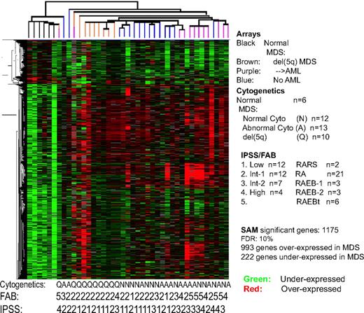 Figure 1. GEPs of MDS versus normal CD34+ marrow cells. This unsupervised hierarchical cluster dendrogram depicts differential branches and GEPs from normal and MDS patients (FDR = 10%). Indicated are the clinical and cytogenetic characteristics of these patients as well as whether they subsequently developed AML (purple) or remained stable (blue or brown). Brown dendrites from the patient arrays were from patients with del(5q) MDS.