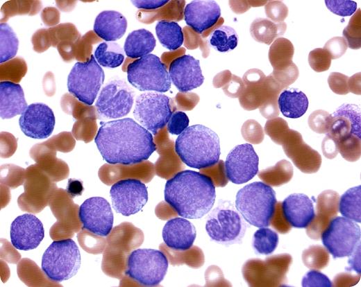 A 62-year-old woman was seen in the emergency room for fatigue. On examination, she was found to have lymphadenopathy affecting the anterior cervical, axillary, and inguinal areas. She also had non-tender hepatosplenomegaly. Complete blood count revealed a hemoglobin of 76 g/L, platelets 99 × 109/L, and severe leukocytosis (297 × 109/L). The differential showed 90% blasts (blood smear shown). / The peripheral smear and the bone marrow blasts were intermediate to large in size, with some prominent nucleoli; 10% were myeloperoxidase positive. Myeloid maturation was also present in a few blasts. Flow cytometry affirmed an abnormal immature myeloid population. Probes for BCR-ABL were negative. / The patient received emergent leukopheresis in the emergency room. A diagnosis of blast crises secondary to acute myeloid leukemia without maturation (French-American-British classification AML-M1) was made. She was started on chemotherapy, initially with Ara-C and mitoxantrone, and later switched to decitabine. The patient responded well to the treatment.