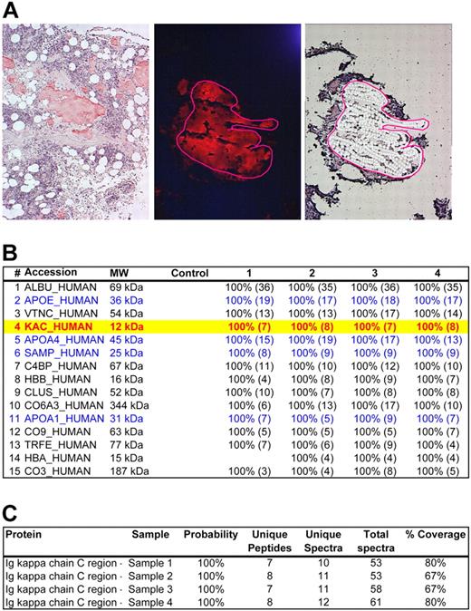 Figure 1. LMD/MS analysis of a case of AL-kappa amyloidosis (case 1). (A) Bone marrow specimen with interstitial nodules of amyloid deposition (Case 1). (Left) CR-stained section viewed under bright field confirming congophilia of the amyloid deposits. (Middle) CR-stained section viewed under fluorescent light source. The congophilic deposits give bright red fluorescence, confirming amyloid deposition. The area selected for microdissection is circled with a red line. (Right) Same area selected in the middle panel after microdissection of the amyloid plaque. Photograph (left) was taken with a DP70 Olympus camera (Olympus) with an Olympus BX51 microscope (Olympus); images were acquired by the use of a DP Controller 2002 (Olympus) and processed with Adobe Photoshop Version 7.0 (Adobe Systems). Other photographs (middle and right) were taken with a HV-D20 Hitachi camera (Hitachi Kokusia Electric Inc) by use of a Leica DM6000B microscope (Leica Microsystems GmbH); images were acquired with Leica Laser Microdissection LMD software (Version 6.6.0; Leica Microsystems). Fluorescence images were obtained by use of a triple band pass filter (B/G/R fluorescence filter; Leica Microsystems). Original magnifications: ×100 (left); ×200 (middle and right). (B) The list of proteins identified from the microdissected amyloid fragments are shown above in panel A. The proteins are listed according to the abundance they were represented in the sample. The panel shows the protein accession code in the UniProt database,19 the molecular weight of the protein (MW), the results of the blank control sample, and 4 different microdissections (1-4) For each protein identified in each sample, statistical probability is indicated as a percentage. The numbers in parentheses indicate the number of unique peptides identified belonging to a given protein. Of the 4 common types of systemic amyloidosis specifically studied (SAA, TTR, IGK, IGL), the samples contained peptides only belonging to IGK constant region (Accession: KAC_HUMAN, highlighted in yellow with red text). In addition, the samples contained several proteins known to be associated with amyloid deposits, such as apolipoprotein E (Accession: APOE_HUMAN), apolipoprotein A4 (Accession: APOA4_HUMAN), SAP (Accession: SAMP_HUMAN), and apolipoprotein A1 (Accession: APOA1_HUMAN). These are indicated in blue text. Other proteins seen include normal components of bone marrow stroma such as vitronectin (Accession: VTNC_HUMAN) and collagen (Accession: CO6A3_HUMAN). Given that the only amyloidogenic protein belonging to the 4 common types of amyloidosis was IGK, this case was typed AL-kappa-type by MS. This result was consistent with the previous gold standard diagnosis. (C) Detailed results of IGK constant region (Accession: IGKC_HUMAN) identified in all 4 cases samples. Probability of protein identification, the number of unique peptides, unique spectra, and total spectra and percent coverage of the protein are shown. A more detailed analysis of the proteomic data is provided in supplemental Figure 1.