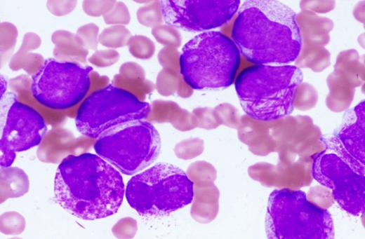 Figure 1. The bone marrow aspirate shows numerous abnormal promyelocytes with prominent cytoplasmic granules, characteristic of hypergranular acute promyelocytic leukemia. Some of these cells exhibit reniform or bilobed nuclei, and several cells contain multiple Auer rods. The blood smear from this patient showed a pancytopenia with rare abnormal promyelocytes. Wright-Giemsa stain. Slides were viewed with an Olympus BX51 microscope using a 100×/1.4 oil-objective lens. Images were acquired with Olympus DP70 and 71 cameras and Olympus DP70 and 71 software. Images were not manipulated.