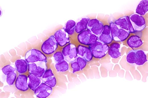Figure 2. This blood smear shows characteristic morphologic features of microgranular acute promyelocytic leukemia (M3V). A prominent leukocytosis is present with numerous cells exhibiting bilobed or monocytoid-appearing nuclei. Cytoplasmic granulation is absent to inconspicuous. Rare cells contained Auer rods (not shown in this field). Wright-Giemsa stain. Slides were viewed with an Olympus BX50 microscope using a 60×/1.4 oil-objective lens. Images were acquired using Olympus DP70 and 71 cameras and Olympus DP70 and 71 software. Images were not manipulated.