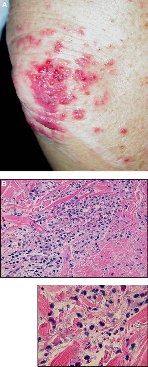 Figure 4. Clinical photograph of the elbow and skin biopsy from a patient with APL treated with ATRA and chemotherapy who developed a rash on day 18 of initial therapy. (A) Coalescing cluster of erythematous papules and pustules with scattered satellite papules on the upper extremity. (B) Histopathology at low power reveals a subepidermal blister with marked dermal edema and a mixed interstitial infiltrate composed of neutrophils and mononuclear cells with scattered nuclear debris. At high power, these cells appear to be immature myelomonocytic cells with some extravasated erythrocytes and nuclear debris. Slides were viewed with an Olympus BX41 microscope using a 40× (A) and a 60× (B) dry lens. Images were acquired using Olympus DP70 and 71 cameras and Olympus DP70 and 71 software. Images were not manipulated.