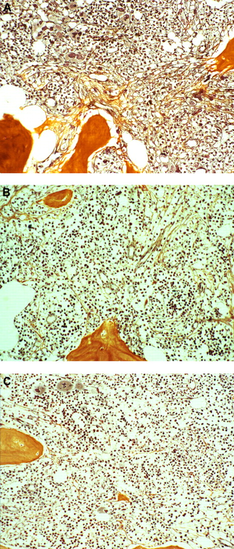 Figure 2. Representative fibrosis regression after dose-reduced allograft. Bone marrow fibrosis grade 3 before transplantation (A), grade 1 after engraftment on day 30 (B), and grade 0 on day 100 after allogeneic stem cell transplantation (C). Image acquisition specifications: Zeiss Axioplan microscope; magnification ×180, oil; Plan Apochromat 20×/0.60 imaging medium/solution; Axiocam HRC camera; Adobe Photoshop software.