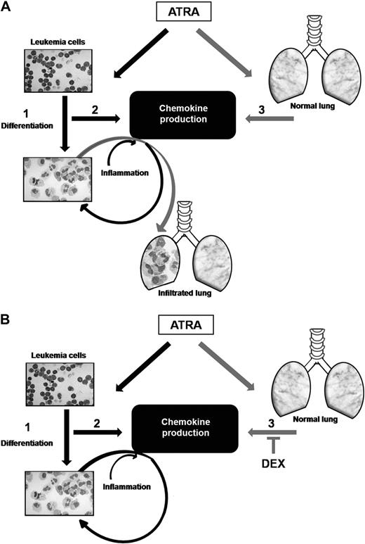 Figure 6. Model of the role of chemokines and dexamethasone in the DS. Schematic representation of the role of chemokines (A) and dexamethasone (B) in the DS. (A) ATRA forces APL blasts to differentiate into mature granulocytes (MGG staining ×400). (1) In addition, ATRA induces chemokine production by the differentiating APL cells (2) as well as by alveolar epithelial cells (3). Alveolar chemokine secretion triggers the migration of differentiating APL cells to the lung (gray arrows). Enhanced migration of leukemic cells in response to massive chemokine production by the differentiating APL cells infiltrating the lung (black arrows) will aggravate the hyperinflammatory reaction in the lung. (B) Reduction of the alveolar chemokine secretion by dexamethasone (DEX) can eliminate the initial trigger for migration of APL cells to the lung and thereby may prevent pulmonary infiltration of APL cells (gray arrows). Dexamethasone does not abrogate the chemokine induction in APL cells. As soon as differentiating APL cells have infiltrated the lung, the ongoing chemokine production by these cells will enhance migration of leukemic cells toward the lung (black arrows), resulting in a severe hyperinflammatory reaction.