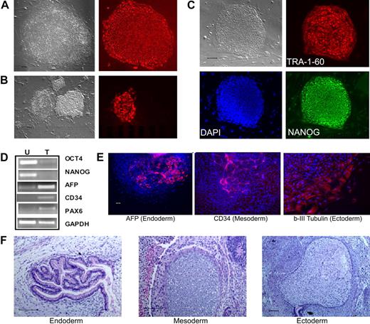 Figure 1. Reprogramming of human CB and adult BM CD34+ cells to iPS cells. (A) Live culture was stained by the TRA-1-60 antibody, 3 to 4 weeks after transduction of CB CD34+ cells. TRA-1-60+ colony shown on right was first seen at week 3 and was picked at week 4 (after restaining). (B) An illustration of various colonies 4 weeks after transduction of BM CD34+ cells, after live staining with TRA-1-60 and a secondary fluorescent reagent. A smaller fraction of formed colonies are TRA-1-60+. TRA-1-60+ colonies were individually picked and gave rise to iPS clones. (C) Immunofluorescence staining images of expanded iPS cells from CB are shown here (BM-derived iPS cells are shown in supplemental Figure 1). In addition to TRA-1-60, they also express other pluripotency markers NANOG and SSEA4. (D) Gene expression of undifferentiated (OCT4 and NANOG) and differentiation markers in undifferentiated iPS cells (U) derived from CB and teratoma cells (T) after in vivo differentiation. The expression of α-fetoprotein (AFP, endoderm), CD34 (mesoderm), and PAX6 (ectoderm) and a housekeeping gene GAPDH was measured by RT-PCR analysis. (E) Differentiation potential of CB-derived iPS cells after in vitro differentiation by EB formation (10 days). After immunofluorescence staining, differentiated cells expressing AFP, CD34, and β-III-tubulin (an ectoderm marker) were seen. The image of specific staining is overlaid by 4,6-diamidino-2-phenylindole staining of nuclei. (F) In vivo differentiation potential after teratoma formation from CB-derived iPS cells. Hematoxylin and eosin staining of various slides after sectioning show various tissues from the 3 embryonic germ layers: gut epithelium (endoderm), cartilage (mesoderm), and glycogenated epithelium (ectoderm). Scale bar represents 200 μm.