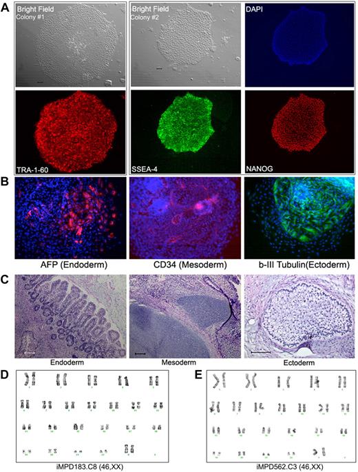 Figure 2. Human iPS lines containing the JAK2-V617F mutation from PB CD34+ cells of 2 MPD patients. (A) Immunostaining of different colonies from a representative iPS line (clone 8) derived from MPD183 shows the expression of undifferentiated cell markers TRA-1-60, SSEA4, and NANOG. (B) A pluripotency test for the iPS clone 8 from MPD183 (iMPD183.C8) after EB formation (day 10) as we did for human ES cells and other (normal) iPS cells, showing that JAK2-V617F iPS cells can also differentiate into various cell types expressing markers of 3 embryonic germ layers. Similar results were obtained from the iPS clone 3 of the second MPD patient (iMPD562.C3) before and after EB-mediated differentiation, as shown in supplemental Figure 4. (C) In vivo differentiation potential after teratoma formation from MPD183-derived iPS cells. Hematoxylin and eosin staining of various slides after sectioning shows various tissues from the 3 embryonic germ layers: gut epithelium (endoderm), cartilage (mesoderm), and glycogenated epithelium (ectoderm). (D-E) Expanded iPS lines from the 2 female MPD patients (D: MPD183; E: MPD562) retained a normal karyotype (46,XX), after 10 and 11 passages, respectively. Scale bar represents 200 μm.