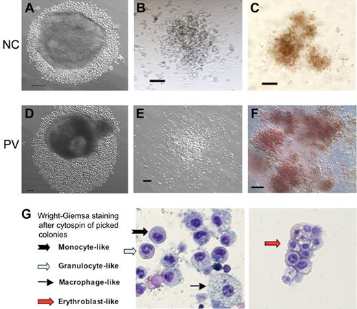 Figure 3. Hematopoietic potential of CD34+ cell–derived iPS cells after directed differentiation. Human iPS cells derived from normal control (NC, A) adult CD34+ cells or the PV CD34+ cells (D) were plated in microtiter wells and aggregated for EB formation and directed hematopoietic differentiation. After 10 to 14 days, substantial numbers of small round cells resembling immature hematopoietic cells surrounding EBs were found and increased in the next several days (A,D). Total cells were subsequently harvested and assayed for the presence of hematopoietic markers (supplemental Figure 4) and of hematopoietic colony-forming units (CFUs) formed in semisolid methylcellulose media (B-C: normal control iPS; E-F: PV-iPS). CFU-granulocyte/monocyte (B,E) and CFU-erythroid (C,F) colonies were observed after additional 10 to 14 days in culture. A similar CFU assay using purified CD34+CD45+ cells from an NC and PV sample is shown in supplemental Figure 5. (G) Wright-Giemsa staining after cytospin of individually picked myeloid and erythoid colonies generated from iPS cells derived from normal CD34+ cells. Cells resembling erythroblasts and multiple lineages of myeloid cells were observed. Scale bar represents 100 μm.