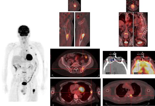 Figure 1. Myeloma deposits are identified by PET-CT in a relapsing patient in the left femur, ribs, thoracic and lumbar spine, and left iliac crest, and a previously unsuspected extramedullary lesion is identified behind the left orbit.