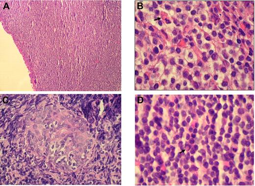 Figure 1. Histologic findings in OAML. (A) Diffuse infiltration of the conjunctiva by a dense small lymphocytic cell population (hematoxylin and eosin, original magnification ×100). (B) Monocytoid cells arranged in sheets in an orbital mass with plasma cell and a Russell body (; hematoxylin and eosin, original magnification ×1000). (C) Lymphoepithelial lesion in lacrimal gland (hematoxylin and eosin, original magnification ×500). (D) Centrocyte-like cells, plasma cells, and Dutcher body () beneath conjunctival epithelium (hematoxylin and eosin, original magnification ×1000). Images of immunohistochemical staining were acquired using a Nikon Eclipse E400 microscope (Nikon) and a Nikon DS-Li digital camera. Digitized images were processed using Adobe Photoshop 7 image processing and manipulation software (Adobe Systems).