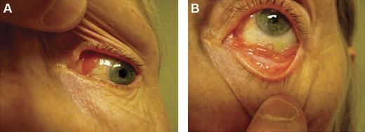 Figure 2. Clinical presentations of OAML. Conjunctival MALT lymphoma with involvement of the nasal bulbar conjunctiva (A) and inferior fornix (B).