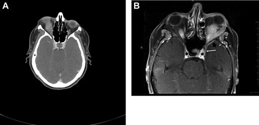 Figure 3. Radiographic presentations of OAML. (A) CT image of right orbital MALT lymphoma involving the inferior rectus muscle, causing mild proptosis. (B) MRI of left orbital MALT lymphoma involving the lateral and inferior rectus muscles, causing medial deviation of the optic nerve, with involvement of the cavernous sinus (white arrow) and mild dural enhancement in the medial anterior cranial fossa (black arrow). Analysis of the cerebrospinal fluid was positive for lymphoma. This case represents an unusual extension of OAML into the central nervous system leading to lymphomatous meningitis.
