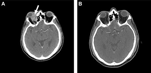 Figure 4. Radioimmunotherapy with Y-90 ibritumomab tiuxetan (Zevalin). Pretreatment (A) and posttreatment (B) CT imaging of a patient with OAML involving the right orbit (arrow), demonstrating a complete response 12 weeks after radioimmunotherapy.