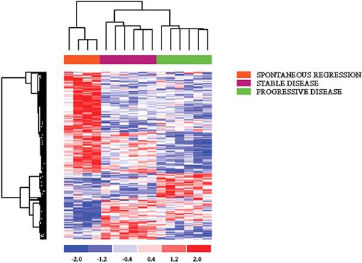 Figure 3. ANOVA analysis comparing patients with CLL in spontaneous regression, stable, or progressive disease. The first group displayed a very unique pattern, sharing a certain degree of commonality with the group of stable CLL.