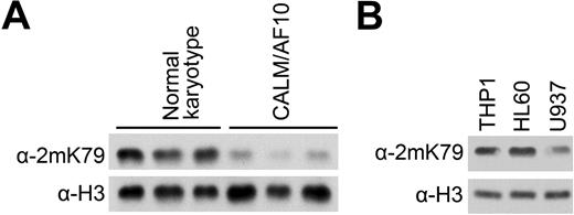 Figure 1. Global H3K79 hypomethylation in CALM-AF10 leukemic cells. (A) H3K79 methylation in leukemia cells with CALM-AF10 rearrangement. Whole-cell extracts were prepared from AML patient samples with normal karyotype or the CALM-AF10 translocation and analyzed by Western blotting with an antibody specific for dimethylated H3K79. Detection with α-H3 antibody (bottom row) provided a loading control. (B) H3K79 methylation in the U937 cell line that expresses the CALM-AF10 fusion. The other 2 monocytic cell lines, HL60 and THP1, were used for comparison.