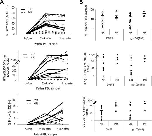 Figure 3. TCR-transduced cells from responding patients persisted and showed antitumor activity ex vivo. Blood samples were taken from patients' cells before and after TCR-transduced cell infusion. PBMCs were evaluated for persistence of infused cells in peripheral blood after treatment by specific tetramer staining and were also used directly in coculture assays with mel624 tumors (MART1+, gp100+, HLA-A2+). Antitumor activity was evaluated by IFN-γ and IL-2 ELISPOT, and also by intracellular staining for IFN-γ production. (A) Persistence and activity of DMF5 patient treatment cells before, 2 weeks after, and 1 month after infusion. Responding (PR) and nonresponding (NR) patients are represented by solid and broken lines, respectively. (B) Comparison of PBMCs from patients treated with either DMF5 or gp100(154) TCR-transduced cells. Tetramer staining and ELISPOT analysis of IFN-γ and IL-2 production from nonresponding (NR) and responding (PR) patients at 1 month after treatment. All samples had less than 10 ELISPOTs (per 100 000 PBMCs) and less than 1% IFN-γ–positive cells, respectively, against the HLA-A*02− mel888 tumor (data not shown). Patients with objective clinical responses (PR) had higher numbers of antitumor IFN-γ (P = .02) and IL-2 (P = .02) secreting cells than nonresponders (NR).