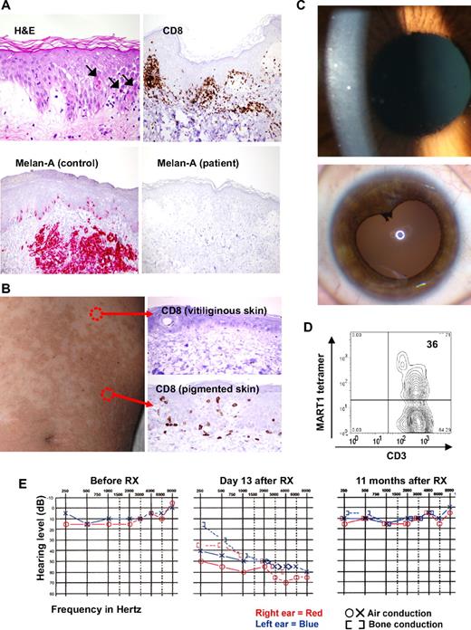 Figure 6. Tissue trafficking and target cell destruction in patients after infusion of TCR-transduced cells. (A) Biopsy of inflamed skin from DMF5 patient 2, day 5 after treatment, demonstrating spongiotic vesicles and necrotic/dyskeratotic keratinocytes (arrows), stained with hematoxylin and eosin, and immunohistochemically stained for CD8+ cells or the Melan-A antibody recognizing MART-1 antigen. (Bottom left) Positive control staining for the anti-MART-1 Melan-A antibody showing normal epidermal melanocytes and a subcutaneous melanoma deposit (original magnification ×20). (B) One week after treatment, biopsies from gp100(154) patient with preexistent patchy vitiligo, demonstrating CD8+ cellular infiltrate into the epidermis of pigmented, but not vitiliginous skin (original magnification ×20). (C) Slit-lamp ophthalmologic evaluation of DMF5 patient 5 eye, 2 weeks after treatment, demonstrating cloudy cellular anterior chamber infiltrate (above) and (below) with induced iris dilation 6 months after TCR treatment and steroid eye drop administration, demonstrating posterior synechiae (asymptomatic). (D) Cells present in ocular fluid from panel C (top), analyzed directly by staining and flow cytometry. (E) Audiologic examination of DMF5 patient 2 before TCR treatment, day 13 after treatment showing hearing loss, and 11 months after treatment, showing hearing recovery after intratympanic steroid treatment.