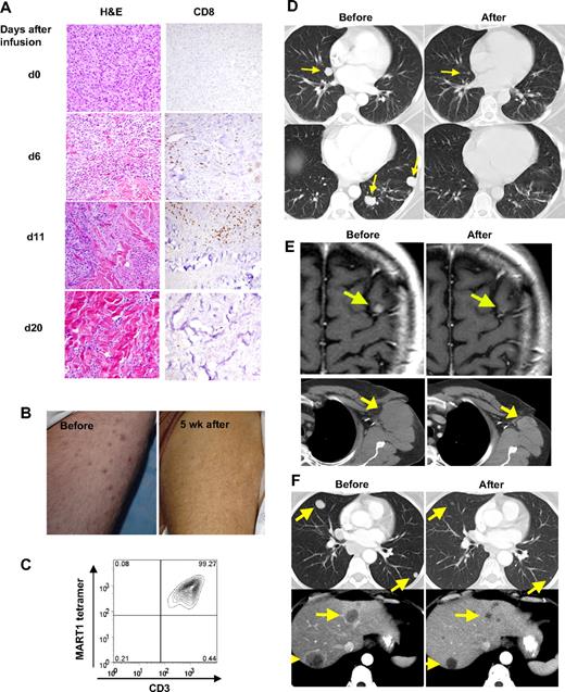 Figure 7. Highly reactive transferred cells traffic to and destroy melanoma tumors in patients. (A) Sequential biopsies of subcutaneous tumors from DMF5 patient 4 before (d0) and after treatment, stained with hematoxylin and eosin (left), or anti-CD8 (right). Original magnification ×20. (B) DMF5 patient 4 thigh covered with multiple subcutaneous melanoma lesions before treatment, and after partial tumor regression 5 weeks after treatment. (C) Flow cytometry of TILs grown from DMF5 patient 4 subcutaneous tumor resected 4 weeks after treatment. (D-F) Before treatment and after treatment CT scans of (D) DMF5 patient 2 lungs, (E) DMF5 patient 8 brain (top) and axilla (bottom), and (F) gp100(154) patient 14 lungs (top) and liver (bottom). Arrows represent location of melanoma metastases.