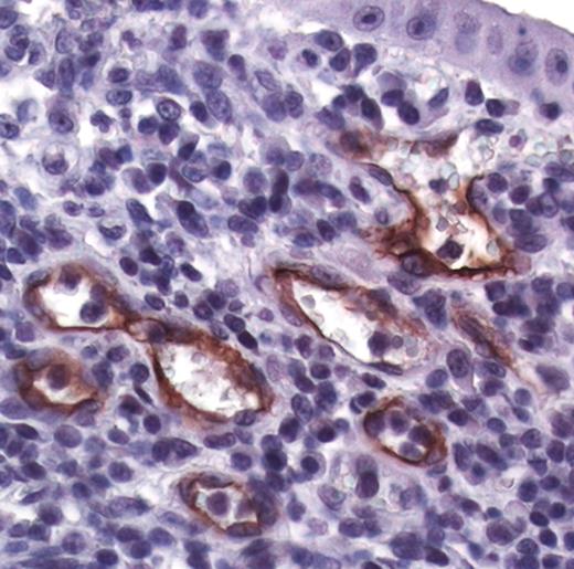 MECA-79 staining of vessels in ulcerative colitis. A section of inflamed colonic mucosa from an ulcerative colitis patient was immunostained with MECA-79 by standard procedures. Signal (brown) is present on vascular endothelial cells in several HEV-like vessels. This result is in agreement with the report of Kobayashi et al.9 The immunohistochemistry was performed by Mark Singer. The paraffin block was provided (UCSF Committee of Human Research approval no. H1060-28 724). This research was supported by NIH grants by Dr Annemieke Van Zante, Department of Pathology, UCSF. R01-GM57411 and R01-GM23547 to S.D.R.