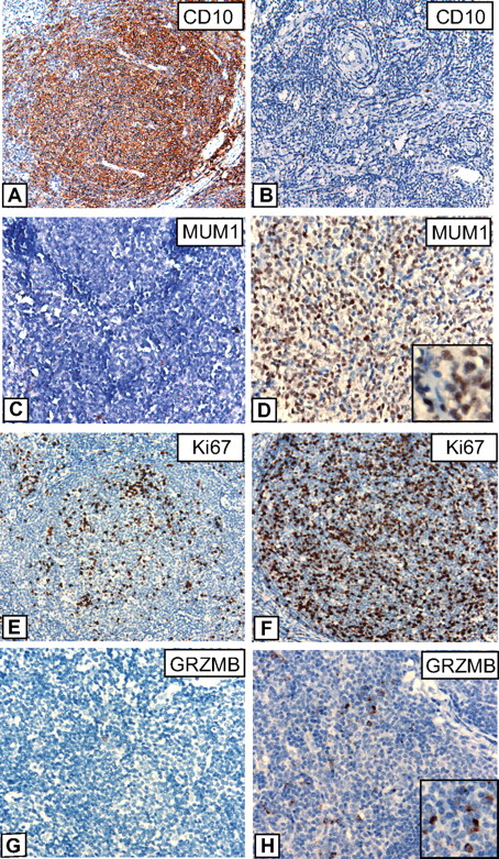 Figure 5. Immunohistochemistry in FLs with and without t(14;18). Representative stainings for CD10, IRF4/MUM1, Ki67, and Granzyme B (GRZMB) in FL grade 1/2 cases with t(14;18) (A, C, E, G) and without t(14;18) (B, D, F, H). (A-B) Images were captured at magnification ×200, and (C-H) at magnification ×400 with the use of an Olympus, Color View, BX50 microscope, the Color View digital camera, and the analysis work soft imaging system (all Olympus).