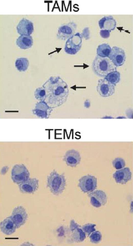 Morphologic appearance of tumor-associated macrophages (TAMs) and Tie2-expressing monocytes (TEMs). Arrows indicate large macrophges containing conspicuous cytoplasmic phagogomes. Scale bar: 30 μm. Photos are representative of n = 25 photos/sample. See the complete figure in the article beginning on page 901.