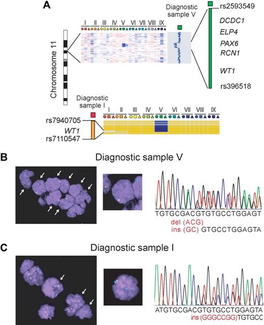Figure 1. Hemizygous deletion of WT1 in T-ALL. (A) Chromosome 11 ideogram and copy number (top) and LOH analysis (bottom) of paired diagnostic (squares), relapsed (triangles), and remission (circles) T-ALL samples. Flanking SNPs and genes included in these alterations are indicated. Roman numbers identify individual patients. (B) FISH and mutation analysis of WT1 in diagnostic sample V. (C) FISH and mutation analysis of WT1 in diagnostic sample I. A chromosome 11 centromeric probe is shown in blue. An intact WT1 locus is marked by an orange signal from a WT1 BAC clone labeled in green and BAC clones telomeric and centromeric to WT1 labeled in red. Arrows indicate nuclei with hemizygous deletions of WT1. DNA sequence chromatograms focus in the WT1 exon 7 sequences containing frameshift mutations of WT1 in each of these samples. Note that, although areas of LOH are marked across diagnostic, remission, and relapsed samples, this corresponds to genetic lesions present in diagnostic and/or relapsed samples compared with the corresponding normal remission DNA.