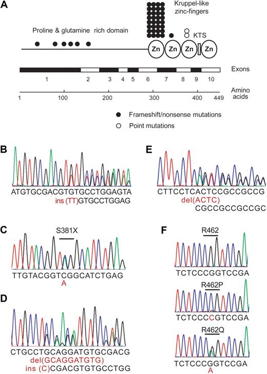 Figure 2. Somatic mutations in WT1 in T-ALL. (A) Schematic representation of WT1 mutations identified in primary T-ALL samples. (B-F) DNA sequence chromatograms showing representative examples of different mutations in WT1. (B) Frameshift truncating mutation in exon 7 of WT1. (C) Nonsense point mutation in exon 7 of WT1. (D) Acceptor site mutation affecting exon 7 of WT1. (E) Frameshift truncating mutation in exon 1 of WT1. (F) Missense mutations involving R462 in the DNA-binding domain of WT1.