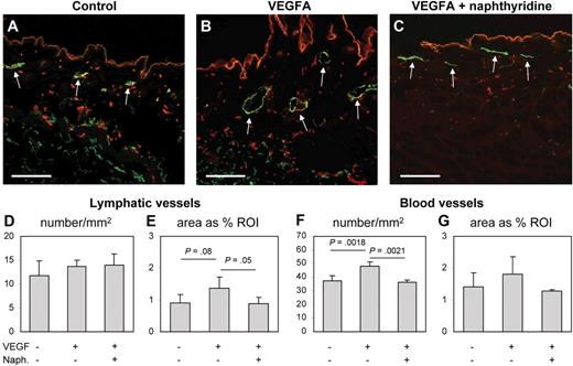 Figure 7. The adenosine A1 receptor antagonist naphthyridine inhibits VEGFA-induced angiogenesis and lymphatic vessel enlargement in mice. VEGFA-containing Matrigel plugs were implanted subcutaneously into adult mice, and the mice were subsequently treated systemically with naphthyridine or with vehicle control for 6 days. (A-C) Differential immunofluorescence analysis for the lymphatic-specific marker LYVE1 (green, examples highlighted by arrows) and the pan-vascular marker CD31 (red) demonstrated lymphatic vessel enlargement and enhanced numbers of blood vessels in the skin surrounding VEGFA-containing Matrigels (B), compared with Matrigels containing PBS (A). Treatment with naphthyridine resulted in a reduction of blood vessel numbers and lymphatic vessel enlargement (C). (D-G) Quantitative image analyses confirmed that the density of lymphatic vessels was unchanged by VEGFA alone or by combined VEGFA and naphthyridine treatment (D). In contrast, the tissue area covered by lymphatic vessels surrounding VEGFA-containing Matrigels was significantly reduced by treatment with naphthyridine (E). Treatment with naphthyridine also reduced the number of VEGFA-induced blood vessels (F) and the tissue area covered by blood vessels (G). Scale bars represent 100 μm.
