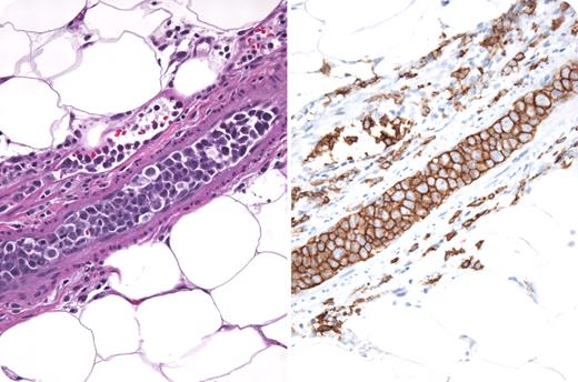 A 74-year-old woman presented with 6 months of fatigue, fevers, chills, dyspnea, weight loss, and blurry vision. Physical examination revealed only fever and mild splenomegaly. She had mild anemia, thrombocytopenia, lactic dehydrogenase that was 3 times normal, a markedly increased sedimentation rate, and hypoalbuminemia. CT/MRI of the head and body revealed no additional abnormalities. Bone marrow examination demonstrated moderate fibrosis, normal cytogenetics, and no dysplasia. She developed new skin nodules and a biopsy was performed. The photograph shows intravascular “plugs” composed of large atypical CD20 B cells with aberrant expression of CD5. Diagnosed as intravascular lymphoma (IVL), she received chemotherapy with rituximab (EPOCH-R) that resulted in a complete resolution of symptoms and disappearance of the skin nodules. IVL are rare, aggressive extranodal diffuse large cell lymphomas, characterized by intravascular malignant lymphoid tumor cells with a remarkable sparing of lymph nodes and nonvascular organ parenchyma. IVL are generally positive for CD19, CD20, CD22, CD79a, and occasionally CD5. Certain tumor cell surface molecules, such as CD11a/49d, may bind to CD 54/106 on endothelial cells and result in vascular compartmentalization. Clinical presentation is diagnostically challenging and nonspecific; nearly half of cases present with fever of unknown origin. Anemia, high lactic acid dehydrogenase levels, and high sedimentation rates are typical. CNS manifestations are also common and often fatal. More than half of cases are diagnosed postmortem; therefore, a high index of clinical suspicion is paramount. Median survival is 5.5 months; however, anthracycline-based regimens in combination with rituximab have proven successful. CNS-directed therapy is recommended for patients with neurologic symptoms.