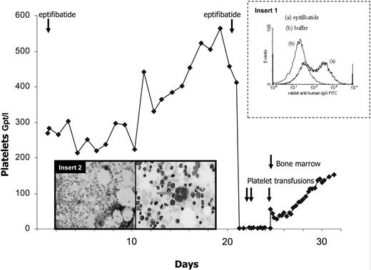Figure 1. Clinical platelet count, antibody-binding characteristics, and bone marrow samples. The graph shows the time course of platelet counts in relation to 2 exposures to eptifibatide in a 67-year-old male patient with acute coronary syndrome (body weight 80 kg; compensated renal impairment). Inset 1 represents the increased binding of IgG, when normal platelets were incubated with patient serum in the presence of eptifibatide (1 μg/mL) but not in the presence of patient serum and buffer, as assessed by flow cytometry. Inset 2 represents a representative example of the bone marrow obtained on day 4 after start of thrombocytopenia. The left panel represents, in an overview, the reduced megakaryocyte count at a 10-fold magnification. Higher magnification (right panel, 60-fold magnification) reveals the young phenotype of the megakaryocyte marked with an arrow from overview microscopy at the left panel. Smears were stained by May-Gruenwald and Giemsa stain (Merck) following standard protocol (microscope: Olympus BX50F; objectives: UPlan FL 10×/0.30; PlanApo 60×/1.40 with oil; camera: ColorView Illu; software: AnalySIS Five; all Olympus Europe).