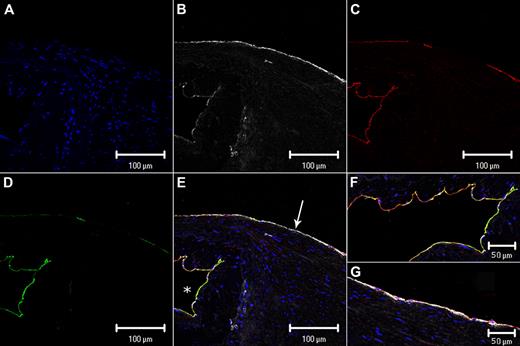Figure 2. Split and merged confocal images of a representative venous valve and vein wall. (A) 4′,6-diamidino-2-phenylindole hydrochloride (blue) binds to DNA; (B) VWF (white); (C) EPCR (red); (D) TM (green); (E) merged image (the overlap of red and green fluorophores is perceived as yellow); (F) higher magnification of the merged image of the valve sinus and (G) higher magnification of the merged image of the vein lumenal wall just distal to the valve images in A-D. (F-G) Images were inserted to include an extended area of both the valvular sinus endothelium and the nonvalvular endothelium distal to the valve (see supplemental data). White arrow in panel E indicates vein luminal endothelium; and white asterisk, valve sinus. Scale bars indicate 100 μm (A-E) and 50 μm (F-G).