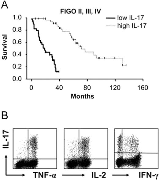 (A) Survival of ovarian cancer patients (pooled stages II, III, and IV) stratified by high (above median) or low (below median) number of IL-17–expressing cells in tumor-infiltrating T cells. (B) Coexpression of multiple proinflammatory cytokines by IL-17–expressing cells in the tumor-infiltrating T-cell population. See the complete figure in the article beginning on page 1141.