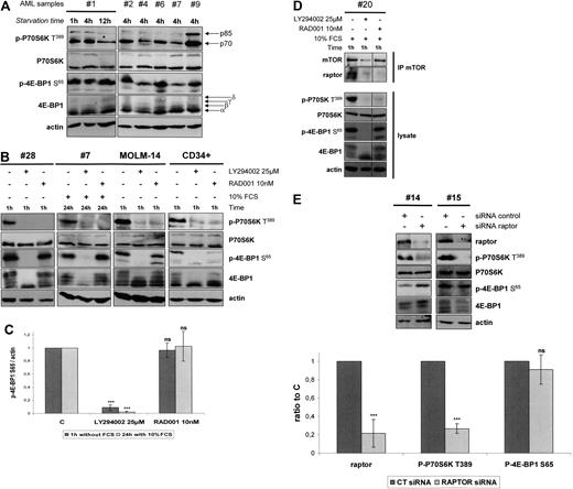 Figure 3. 4E-BP1 phosphorylation escapes mTORC1 in AML. (A) Samples from AML patients were starved for 4 hours in cytokine- and serum-free medium, except for sample 1, starved for 1, 4, and 12 hours, and then lysed in Laemmli sampler buffer. Western blot was performed with anti–phospho-P70S6K T389, anti–phospho-4E-BP1 S65, anti-P70S6K, anti–4E-BP1, and antiactin antibodies. Five representative samples of AML are depicted in panel A. (B) Bone marrow blast cells from 8 AML patients, cells from the MOLM-14 leukemic cell line, and normal CD34+ immature hematopoietic cells were starved for 4 hours in cytokine- and serum-free medium. A total of 10 nM RAD001 or 25 μM LY294002 was added during the last hour of starvation. Blast cells from 8 other AML patients were cultured for 24 hours in αMEM containing 10% FCS without or with 10 nM RAD001 or 25 μM LY294002. Proteins extracts from 106 cells were resolved by SDS-PAGE electrophoresis, transferred to nitrocellulose, and probed with anti–phospho-P70S6K T389, anti–phospho-4E-BP1 S65, anti-P70S6K, anti–4E-BP1, and antiactin antibodies. (C) Western blot signals from experiments done in primary blast cells (B) were quantified using the Multi Gauge, Version 3.0 software from Fuji. Ratios of phospho-4E-BP1 S65/actin signal intensity were first calculated to correct for loading variations. Results were expressed relative to the control condition (without inhibitor) in each experiment. Each histogram represents the mean of 8 independent experiments. Vertical bars represent SD. (D) Primary AML cells were cultured without or with RAD001 during 1 hour and lysed in 0.3% CHAPS buffer. Then mTOR was immunoprecipitated (with goat anti-mTOR antibody from Santa Cruz Biotechnology), and Western blot was performed using anti-mTOR and antiraptor antibodies. Whole-cell extracts collected before mTOR immunoprecipitation were submitted to Western blots using anti–phospho-P70S6K T389, anti–phospho-4E-BP1 S65, anti-P70S6K, anti–4E-BP1, and antiactin antibodies. (E) Bone marrow blast cells from 6 AML patients were transfected with 1 μM raptor siRNA or 1μM nontargeted control siRNA. Cell extracts were analyzed by Western blot 24 hours after electroporation to assess the expression of raptor and the phosphorylation level of P70S6K on T389 and of 4E-BP1 on S65. The intensities of phospho-4E-BP1 S65, phospho-P70S6K T389, and actin signals were quantified using the Multi Gauge, Version 3.0 software from Fuji, and ratios of phospho-4E-BP1 S65 or phospho-P70S6K T389 to actin were calculated and set to 1 for control cultures. Each histogram represents the mean of 6 independent experiments. ***P < .001. ns indicates not significant.