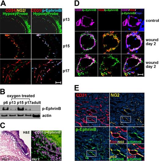 Figure 2. EphrinB phosphorylation marks angiogenic vessels. (A) ROP model: P7 mice were exposed to 75% oxygen tension for 5 days (P12) and then to normal oxygen tension for 1 day (P13), 3 days (P15), and 5 days (P17). Representative confocal images from retinal whole mounts show vascular p-EphrinB in p15 and p17. HypoxyProbe marks hypoxic areas. P13 original magnification ×10 p13 and ×20 p15 and p17. (B) p-EphrinB and actin in retinal extracts from p6, adult, and ROP (P13, P15, and P17) mice detected by immunoblotting. (C) Skin wound-healing model. Representative H&E staining (left) of a 2-day-old wound showing the disrupted epithelium; CD31 and p-EphrinB immunostaining of boxed area (expanded on the right). The epithelium displays intense nonspecific green fluorescence seen from secondary-only antibody. (D) Selected capillaries from control and wounded skin detected by confocal microscopy after immunostaining. (E) MOPC315 tumor model. Tumor vessels (CD31+) show variable pericyte (NG2+) coverage and p-EphrinB expression. The boxed area (expanded bottom right) shows vascular localization of p-EphrinB immunostaining. Scale bars in panels A and D represent 20 μm. Original magnification in panels C and E is ×20.