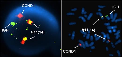 Figure 1. Fluorescence in situ hybridization analysis on interphase and metaphase nuclei (using the LSI IGH/CCND1 XT dual-color, dual-fusion translocation DNA probe) identifying the presence of the t(11;14)(q13;q32) chromosomal translocation. Interphase nuclei are shown in the left panel. One orange (CCND1 on chromosome 11q13), one green (IGH on chromosome 14q32), and 2 fusion signal patterns (der(11) and der(14), indicating the chromosomal rearrangements produced by the translocation) can be observed.