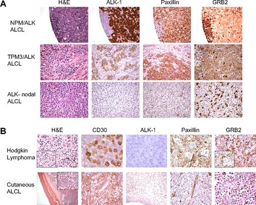 Figure 5. Immunohistochemical validation of paxillin and GRB2 expression in human malignant lymphomas. (A) Tissue microarrays composed of ALCLs (ALK positive and ALK negative) were used to perform immunohistochemical analyses for paxillin and GRB2. The morphologic features evaluated by H&E stains and expression of ALK-1, paxillin, and GRB2 in representative cases of NPM/ALK-positive ALCL, a variant ALK-positive ALCL (TPM3/ALK), and an NPM/ALK-negative nodal ALCL are shown. Paxillin and GRB2 are selectively overexpressed in the ALK-positive lymphoma cells in contrast to the ALK-negative nodal lymphoma cells. (B) The top panel demonstrates the features of a classical Hodgkin lymphoma with strong expression of CD30 in the neoplastic Reed-Sternberg cells that do not express ALK, paxillin, or GRB2. The bottom panel illustrates the morphologic features of a cutaneous ALCL with strong expression of CD30 but without expression of ALK-1, paxillin, or GRB2 within the neoplastic T cells.