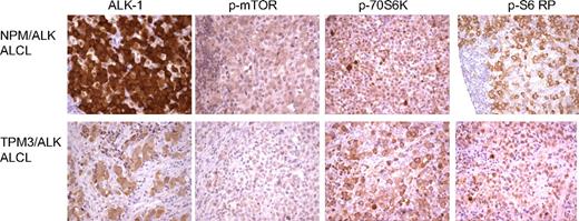 Figure 6. Expression of FRAP/mTOR pathway proteins in ALK-positive ALCLs. Tissue microarrays of ALK-positive ALCLs were analyzed for the expression of proteins in the FRAP/mTOR pathway. Both the NPM/ALK-positive (top panel) and TPM3/ALK-postive (bottom panel) ALCLs demonstrate expression of phospho-mTOR, phospho-p70S6K, and phospho-S6 ribosomal proteins.
