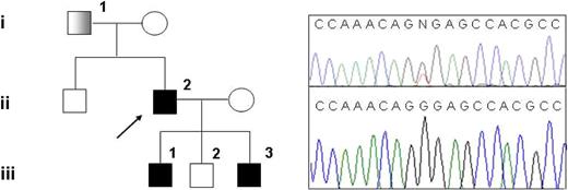 Figure 1. Family pedigree and mutation detection. (Left) Pedigree of the family with hereditary thrombocythemia; ■: thrombocythemia and unilateral limb defect; : thrombocythemia only. (Right top) Sequencing chromatogram showing the G185T heterozygous mutation in subject III-1. (Right bottom) Sequencing chromatogram showing normal sequence in subject III-2.