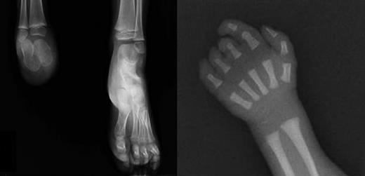 Figure 2. X-rays of limb defects in patients. (Left) Foot x-ray of subject III-1, showing absence of the right foot; the calcaneus and astragalus, that are absent in the father, are present although smaller than the controlateral ones. (Right) X-ray of right hand in subject III-3, showing absence of the last phalange of 2° digit and last 2 phalanges of 3° to 5° digits.