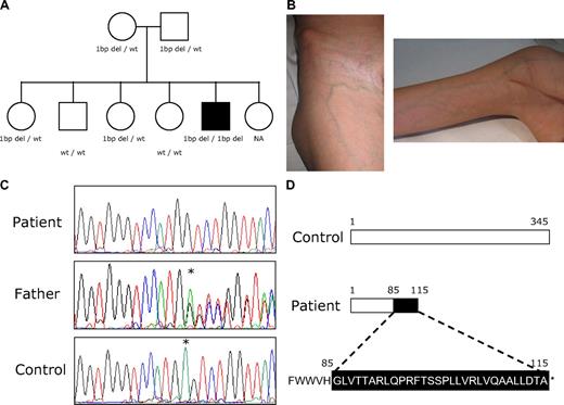 Figure 1. Clinical case. (A) Patient's family tree. The ■ denotes the patient with documented syndromic SCN; and open symbols, unaffected persons. G6PC3 genotype is shown below each symbol. NA indicates not available. (B) Prominent subcutaneous venous circulation detected in the patient. (C) Sequence electropherograms of G6PC3 gene showing the homozygous 1-bp deletion (patient, top line), heterozygous 1-bp deletion (patient's parents, middle line), and wild-type (healthy control, bottom line) genotypes. *Nucleotide position where the 1-bp deletion was detected. (D) Graphic of wild-type G6PC3 protein and predicted changes provoked by the novel homozygous 1-bp deletion detected in the patient.