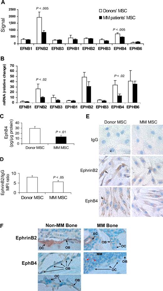 Figure 1. EphrinB2 (EFNB2) and EphB4 (EPHB4) are down-regulated in MM MSCs and in osteoblasts and osteoclasts in myelomatous bones. (A-B) Gene expression of the B family of ephrin ligand and Eph receptor genes in MSCs from MM patients (n = 13) and healthy donors (n = 5) analyzed by GEP (A) and quantitative RT-PCR (B). Note down-regulation of EFNB2 and EPHB4 in MM patient MSCs. (C) Protein level of EphB4 as determined by ELISA, demonstrating reduced total amount of this receptor in patient MSCs. (D) Protein level of ephrinB2 as determined by flow cytometry analysis, demonstrating reduced mean florescent intensity of this ligand in patient MSCs. (E) Representative immunohistochemical analysis revealed reduced levels of ephrinB2 and EphB4 in patient MSCs (original magnification ×200). Note cell surface (↑) and cytoplasmic expression (stained brown) of these factors. (F) Bone sections from myelomatous (MM Bone) and nonmyelomatous (Non-MM Bone) human bones in SCID-hu mice were immunohistochemically stained for human EphB4 and ephrinB2. Note strong expression of EphB4 in osteoblasts in nonmyelomatous bones (bottom left panel), whereas myelomatous bones contained fewer osteoblasts that expressed very low levels of EphB4 (bottom right panel). Osteoclasts (OC) did not appear to express EphB4, whereas hematopoietic cells that seem to be of monocytic lineage (red arrows) highly expressed EphB4 and served as an internal positive control. Also note that ephrinB2 was evident in osteoclasts and osteoblasts in nonmyelomatous bones (top left panel), whereas in myelomatous bones low expression of ephrinB2 was detected in osteoclasts and osteoblasts (top right panel). Vascular endothelial cells (EC) expressed high levels of ephrinB2 in myelomatous bones and served as an internal positive control. An Olympus BH2 microscope equipped with a 160×/0.17 numerical aperture objective (Olympus) was used to obtain images with a SPOT 2 digital camera (Diagnostic Instruments).
