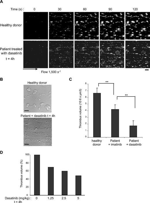 Figure 3. Rapid and dose-dependent effect of dasatinib treatment on platelet thrombus formation on collagen under arterial flow conditions in humans and mice. DiOC6-labeled platelets in whole blood from healthy donor or patients 1 to 4 treated with dasatinib 4 hours earlier were perfused through a collagen-coated microcapillary at a shear rate of 1500 seconds for 2 minutes. Thrombus formation was visualized with a 40× long working distance objective in real time and then imaged using transmitted light microscopy. Representative images are shown (A). After a washing step with phosphate-buffered saline for 2 minutes at the same shear rate to remove nonadherent cells, slides were visualized using differential interference contrast microscopy, and representative images are shown (B). Images were visualized using an epifluorescence microscope (Axiovert 200; Carl Zeiss Inc); 40×/1.3 NA oil objective, no solution, with DiOC6. Images were acquired using a charge-coupled device camera (Cool Snap HQ; Roper Scientific) and Metamorph Version 6.21.6 software. Thrombus volume (C) was measured at 2 surface locations in each of the 4 independent experiments performed from healthy donors, dasatinib-treated patients, and imatinib-treated patients (mean ± SEM). **Significant difference (P < .005), according to Student t test. Scale bar represents 20 μm. The same experiments were performed using whole blood from mice treated with 1.25, 2.5, or 5 mg/kg dasatinib (5 mice per group) 4 hours before blood collection, and the thrombus volumes were measured (D). Results shown are representative of 2 independent experiments.