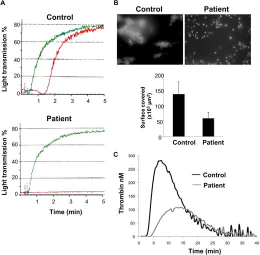 Figure 1. Platelet functional analysis. (A) Platelet aggregation was measured by turbidimetry on PRP from a control subject and the patient. PRP was stimulated by 5 μM adenosine diphosphate (green) and 1 μg/mL collagen (red). (B) Thrombus formation on collagen under blood flow was analyzed using DiOC6-labeled platelets in whole blood perfused at a shear rate of 500 second−1 over a collagen-coated coverslip during 5 minutes. Thrombus formation was visualized in real-time using an inverted microscope (Leica DMIRB) using a lens at 100× and a 488 nm filter. Images were acquired using a DP30BW camera and CellP software (Olympus) and processed with Histolab software (Microvision). Areas covered by platelet thrombi were measured on 10 different, randomly chosen, microscopic fields. (C) Thrombin generation was triggered by the addition of tissue factor (1 pM) to PRP after incubation with 5 μg/mL collagen. Results are from 1 experiment performed in triplicate, representative of 2 independent experiments.