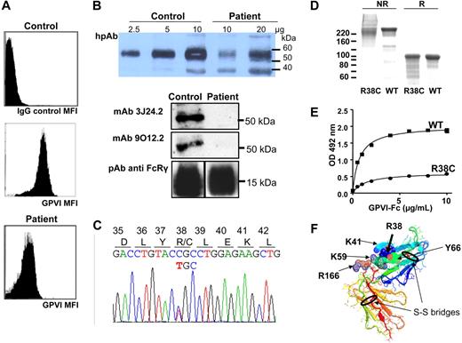 Figure 2. Characterization of the patient's GPVI molecular defect. (A) Flow cytometry on whole blood using the monoclonal antibody 3J24.2 showed decreased GPVI expression on the patient's platelets, compared with control. (B) Serial quantities of proteins in sodium dodecyl sulfate–platelet lysate from the patient or a control were immunoblotted with a human polyclonal anti-GPVI (hpAb). GPVI of the control migrated as a single 58-kDa band, whereas the patient's GPVI migrated as a smear and presented a partial deficiency (note that the 10-μg control GPVI band is saturated; the 35-kDa band is nonspecific). When 10 μg control and patient platelet proteins were immunoblotted with monoclonal antibody 3J24.2 or 9O12.2, the patient's GPVI was hardly detectable. (C) DNA sequence showing the single nucleotide substitution in exon 3 (C172T), resulting in the Arg38 substitution in Cys. (D) Purified recombinant wild-type (WT) and R38C GPVI-Fc were analyzed on sodium dodecyl sulfate–8% acrylamide gels and Coomassie blue staining. WT GPVI-Fc migrated as an approximately 220-kDa band and R38C GPVI-Fc as a smear in nonreducing conditions (NR), and both migrated as a major 95-kDa band after reduction with 5% β-mercaptoethanol (R). (E) Binding of WT and R38C GPVI-Fc to immobilized collagen. Results represent mean ± SD of 2 experiments performed in triplicate. The Kd values are 1.67 ± 0.26 μg/mL and 1.4 ± 0.17 μg/mL for R38C and WT GPVI-Fc, respectively. (F) Three-dimensional structure of the extracellular domain of GPVI with localization of R38. R38 and other important residues for collagen binding, such as K59, K41, and R166,6 are localized on the extracellular domain of GPVI as crystallized by Horii et al.8 The 2 disulfide bridges are represented and encircled in black.