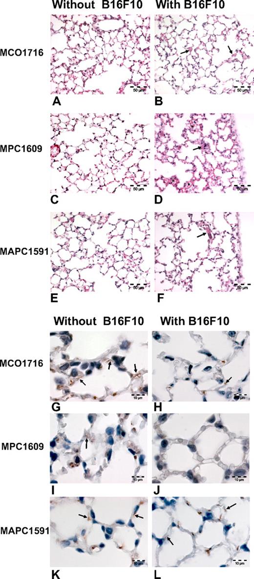 Figure 4. Endogenous APC protects the endothelial barrier by inducing VE-cadherin expression. Lung histology was assessed in C56Bl/6 mice treated with 200 μg control MCO1716 antibody (A,B,G,H) or APC blocking antibodies MPC1609 (C,D,I,J) or MAPC1591 (E,F,K,L) in the presence (B,D,F,H,J,L) or absence (A,C,E,G,I,J) of B16F10 cancer cells. (A-F) hematoxylin–eosin staining section showing normal histology of lungs treated with antibody alone (A,C,E) and virtual normal histology of lungs containing B16F10 cancer cell () and treated with MCO1716 (B) and MAPC 1591 antibody (F). Treatment with cancer cells at 1 hour after inoculation and MPC1609 antibody caused accumulation of erythrocytes in the alveolar walls (*), indicating extravasation (D). Bar = 50 μm. (G-L) Immunohistochemical staining of VE-cadherin showing endothelial cell adherens junctions () in lungs treated with antibody alone (G,I,K). Adherens junctions in lungs at 1 hour after cancer cell inoculation and treatment with MCO1716 and MAPC 1591 antibody was reduced in comparison to lungs that did not receive cancer cells. Adherens junctional staining is completely lost after treatment with cancer cells and MPC1609 antibody (J). In this case the alveolar walls were swollen. Erythrocytes were also stained positive for VE-cadherin. Bar = 10 μm.