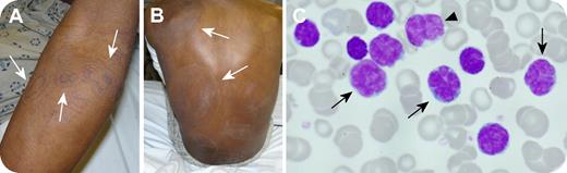 A 36-year-old man from Jamaica developed progressive superficial desquamating, circular, hypopigmented lesions over a 4-month period, accompanied by weight loss. He had no previous rashes and no history of infections or malignancies. Tuberculosis and HIV tests, performed for immigration purposes, were negative. / On examination, skin lesions were disseminated over his arms (panel A), legs, neck, chest, and back (panel B). Several lesions measured up to 20 cm in diameter. Multiple small lymph nodes that became progressive were noted in the axillary and inguinal regions. A computed tomographic scan demonstrated diffuse lymphadenopathy, including involvement of the paratracheal and mesenteric regions and hepatosplenomegaly. / The white blood cell count was 293 × 109/L (89% lymphocytes, 11% neutrophils) and flow cytometry on the peripheral blood demonstrated a population of lymphocytes positive for CD3, CD4, CD25, and CD52, that was monoclonal for the αβ chains of the T-cell receptor by gene rearrangement studies. A peripheral blood film showed classic “flower cells” (panel C, arrows) and abnormal-appearing lymphocytes with deep nuclear clefts (panel C arrowhead). Skin, node, and bone marrow biopsies confirmed T-cell lymphoma/leukemia. HTLV-1 was positive by polymerase chain reaction. / He received chemotherapy with CHOP and hyper-CVAD regimens, achieving a response in his lymphocyte counts, but his skin lesions progressed until interferon and zidovudine were started. He returned to Jamaica for completion of his treatment with a complete hematologic response and near complete resolution of his skin rash.